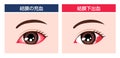 Illustration comparing subconjunctival hemorrhage and conjunctival congestion Royalty Free Stock Photo