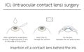 Illustration, Correction of vision with ICL intraocular contact lens, Medical illustration