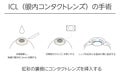 Illustration, Correction of vision with ICL intraocular contact lens, Medical illustration. - Translation: intraocular contact