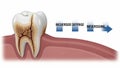 Illustration of a Decayed Tooth with Labels Indicating Progression of Dental Issues teeth Royalty Free Stock Photo