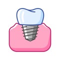 Illustration of dental implant. Dentistry and health care icon. Stomatology medical item. Royalty Free Stock Photo