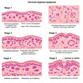 Illustration depicting stages of cervical dysplasia. Each stage is represented with Royalty Free Stock Photo