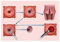 Illustration describing the process of cauterization of the cervix affected by cancer Royalty Free Stock Photo