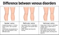 Illustration of difference between venous disorders Royalty Free Stock Photo