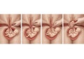 Illustration of the ECV (External Cephalic Version) procedure in a uterus, showing four stages of Royalty Free Stock Photo