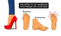 Illustration of the effect of wearing narrow shoes on our feet