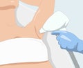 Illustration.Elos epilation, hair removal procedure on a womanâs body.