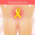 Illustration of Endometriosis in woman