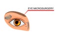 Illustration of the eye, the eyeball. microsurgery