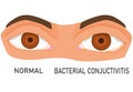Illustration of eyes with bacterial conjunctivitis. eye diseases. eye irritation. flat vector.
