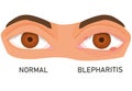 Illustration of eyes with barley. eye diseases. eyelid inflammation. blepharitis. flat vector. Royalty Free Stock Photo