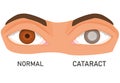 Illustration of eyes with cataract. eye diseases. vision loss. flat vector. healthy and diseased eye.