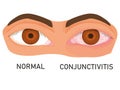 Illustration of eyes with mucous membrane irritation. healthy eye and with conjunctivitis.