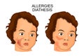 Illustration of the face of a child suffering diathesis or Allergy