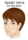 Illustration of the facial spider veins