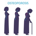 illustration of final stage of osteoporosis, joint pain medical vector infographic