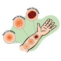 Illustration first aid arm types of burns and injury