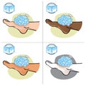 Illustration of first aid person ethnicity, foot with ice bag, side view