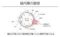 Illustration, Glaucoma of the eye, Medical Illustrations. - Translation: glaucoma in the eye, increased intraocular pressure and