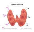 Illustration of the Graves disease causes. Vector scheme showing antibodies binding to the inflamed thyroid causing thyroid to