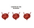 Growth of cancer in the bladder