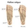 Illustration of Hallux valgus Royalty Free Stock Photo