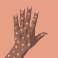 Illustration of a hand of a black man with monkey pox. Royalty Free Stock Photo