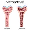 Osteoporosis