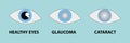 illustration of a healthy eye, glaucoma, cataract Royalty Free Stock Photo