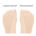 illustration of healthy feet, feet with ingrown toenails, treatment of ingrown
