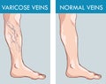 Illustration of a healthy leg and the affected varicose veins.