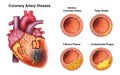 Heart Coronary Problem with Cholesterol Royalty Free Stock Photo