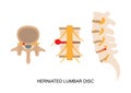 Illustration of herniated lumbar disc in different view Royalty Free Stock Photo