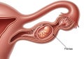 Illustration of a human fallopian tube Royalty Free Stock Photo