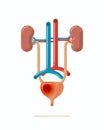 Illustration of human urinary system with disease, flat design vector illustration