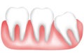 Illustration of Impacted tooth, Tilted tooth or Crowded teeth Royalty Free Stock Photo