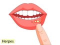 Illustration of infection on female lips. Herpes