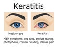 Illustration of Keratitis disease