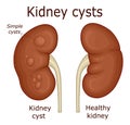 Illustration of kidney cysts