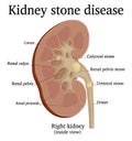 Illustration of Kidney stone disease