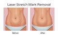 Vector realistic illustration of before and after laser strechmarks removal