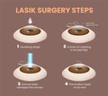 illustration of lasik eye surgery steps