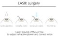 Illustration, LASIK vision correction, medical illustration