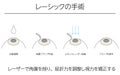 Illustration, LASIK vision correction, medical illustration. - Translation: LASIK surgery, laser shaving of the cornea to adjust Royalty Free Stock Photo