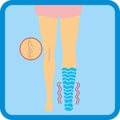 Illustration legs with vascular net legs with edema. adverse pregnancy symptoms