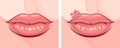 Illustration of lips with herpes