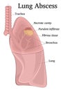 Illustration of lung abscess