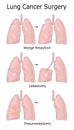 Illustration of lung cancer surgery