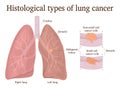 Illustration of lung cancer types Royalty Free Stock Photo