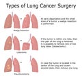 Illustration of lung cancer types Royalty Free Stock Photo